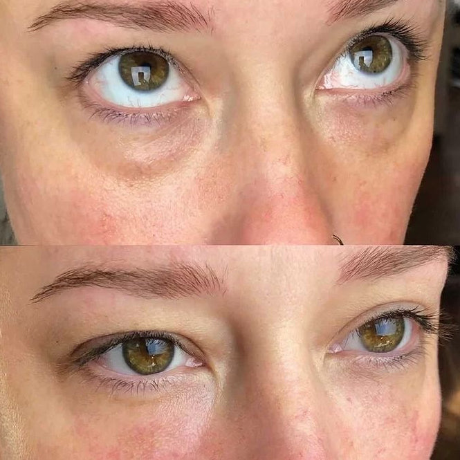 Reduced under-eye puffiness